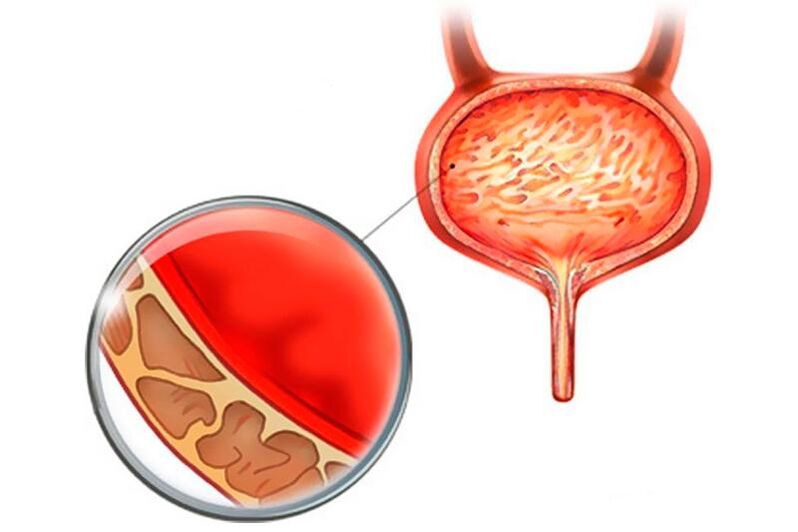 Inflammation of the lining of the bladder with cystitis